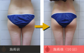 痩身の施術例C