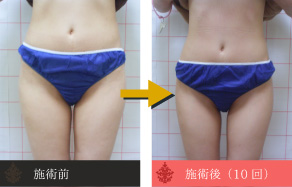 痩身の施術例B